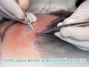 Пересадка волос в височной области