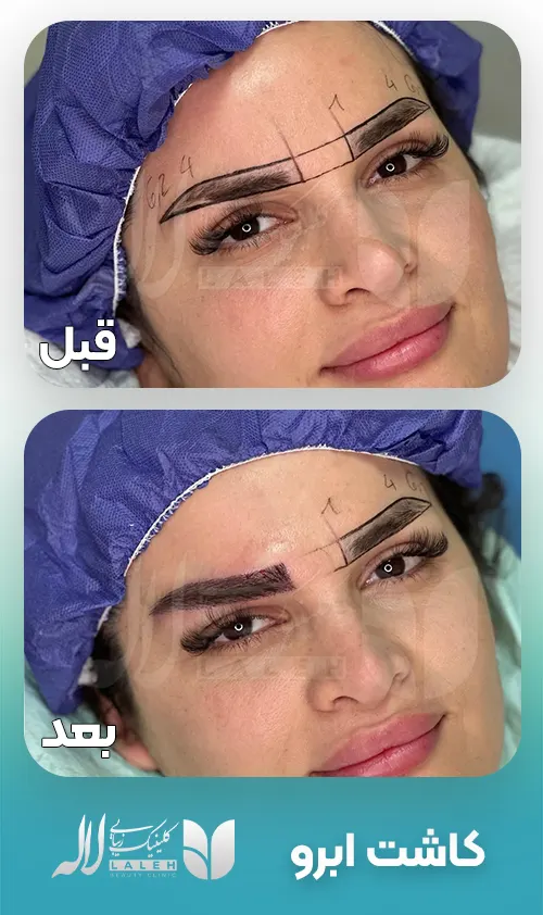 کاشت ابرو