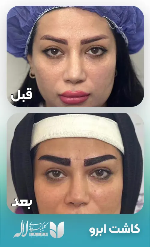 کاشت ابرو