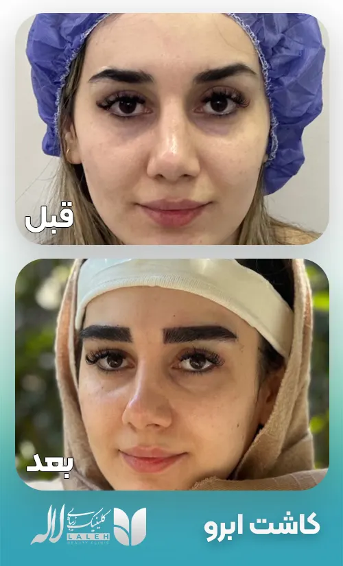 کاشت ابرو