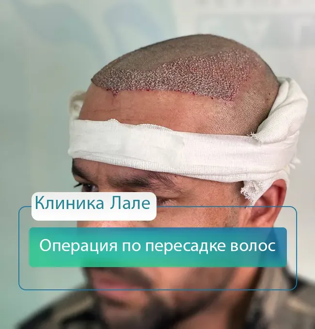 Операция по пересадке волос